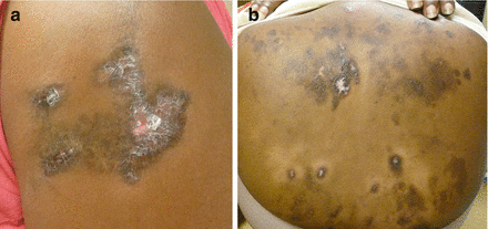 Figure 12 a b Discoid lupus of the body Hyperpigmented plaques with - photo 2