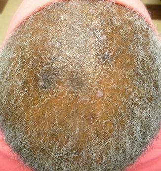 Figure 13 Discoid lupus of the scalp Hyperpigmented plaques with adherent - photo 3