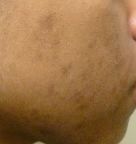 Figure 12 Postinflammatory hyperpigmentation secondary to acne Hyperpigmented - photo 2