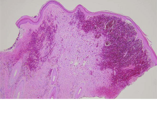Figure 12 Low-power photomicrograph depicting diffuse dermal hemorrhage - photo 2
