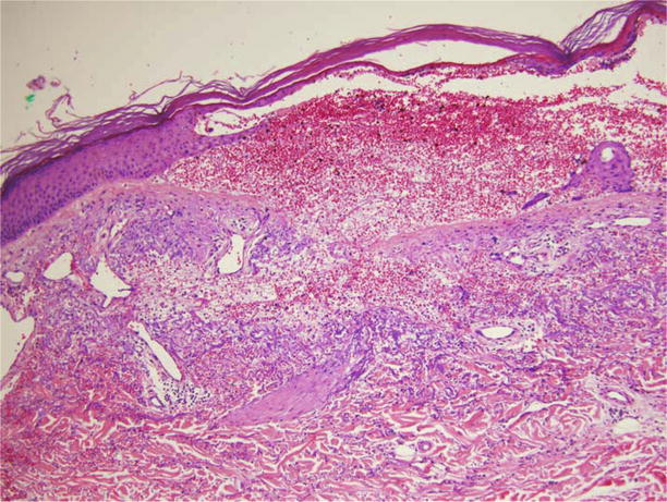 Figure 13 Medium-power photomicrograph depicting subtle proliferation of - photo 3