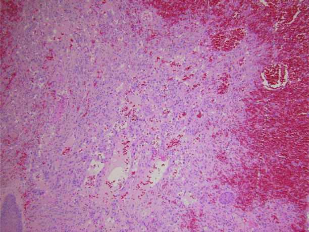 Figure 14 Medium-power photomicrograph depicting deeper dermis with gaping - photo 4