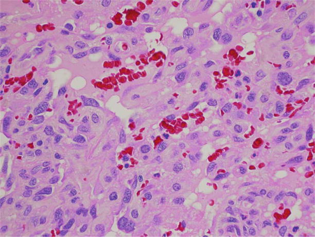 Figure 15 High-power photomicrograph depicting cytologic detail of vascular - photo 5