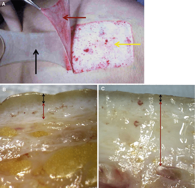 Fig 11 Skin layers A Epidermis a black arrow dermis a red arrow - photo 1