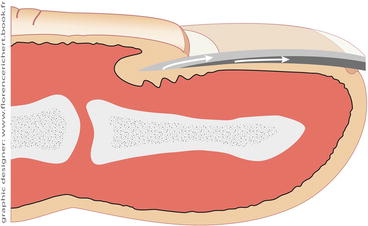 Fig 13 Formation of the nail plate by the matrix the superficial upper third - photo 3