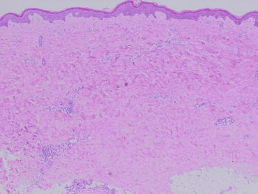 Fig 11 Histopathology of the skin in a patient with SSc showing thickened - photo 1