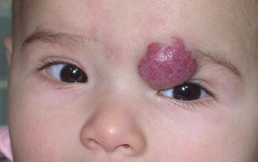 Fig 11 Large infantile hemangioma of the left orbit and upper eyelid - photo 1