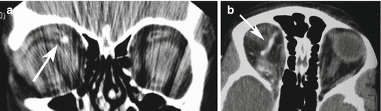 Fig 12 a CT scan demonstrating dilated superior ophthalmic vein arrow - photo 2