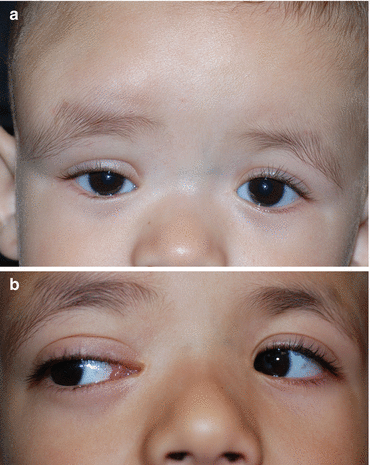 Fig 13 a Extensive lymphangioma of the right forehead brow and orbit - photo 3