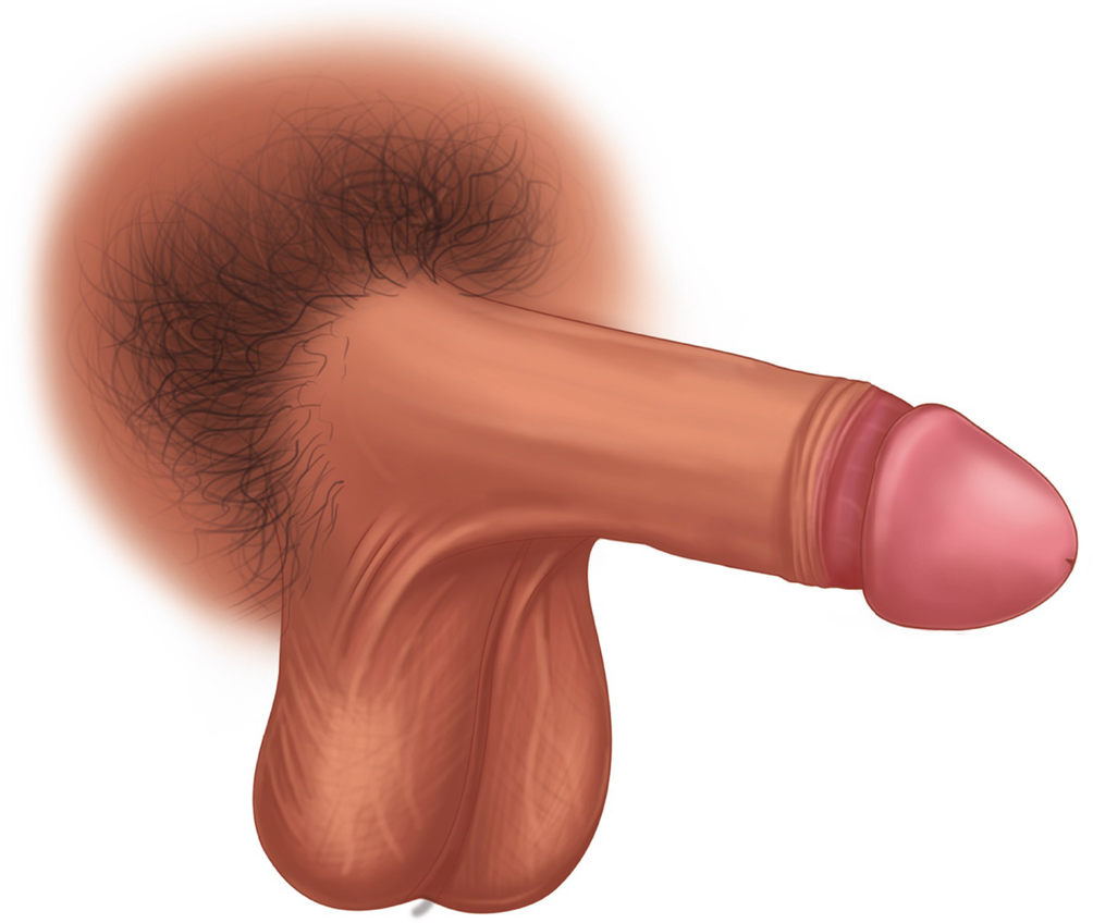 Fig 11 Appearance of male genitalia circumcised Fig 12 Appearance - photo 3