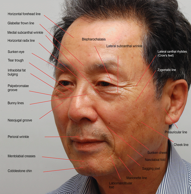 Fig 11 Facial wrinkles in Asians 121 Basic Terminology Related to - photo 1