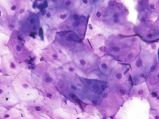 Fig 13 Cytology of stratum spinosum large polygonal spinous cells with - photo 3