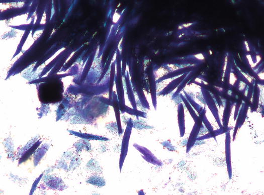 Fig 16 Cytology of the stratum corneum many lanceolate and deeply blue - photo 6