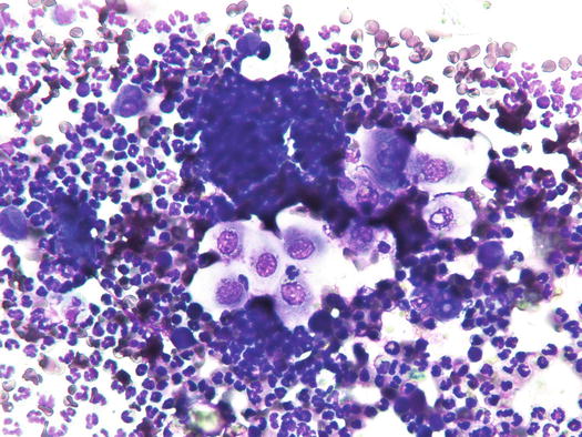 Fig 17 Cytology of dysplastic keratinocytes note the alterations represented - photo 7