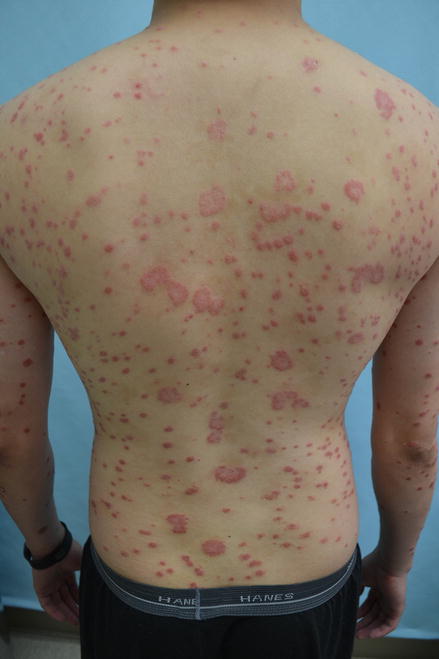 Figure 11 Patient with generalized psoriasis who is a candidate for - photo 1