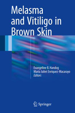 Evangeline B. Handog and Maria Juliet Enriquez-Macarayo Melasma and Vitiligo in Brown Skin