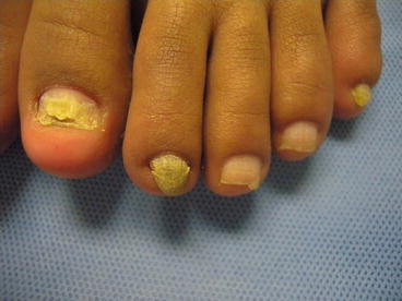 Fig 11 Candida onychomycosis in a patient with chronic mucocutaneous - photo 1