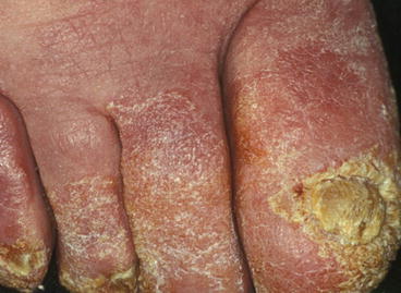 Fig 13 Total dystrophic onychomycosis Note the severe concomitant tinea - photo 3