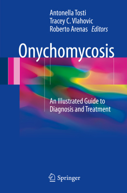 Antonella Tosti Onychomycosis: An Illustrated Guide to Diagnosis and Treatment