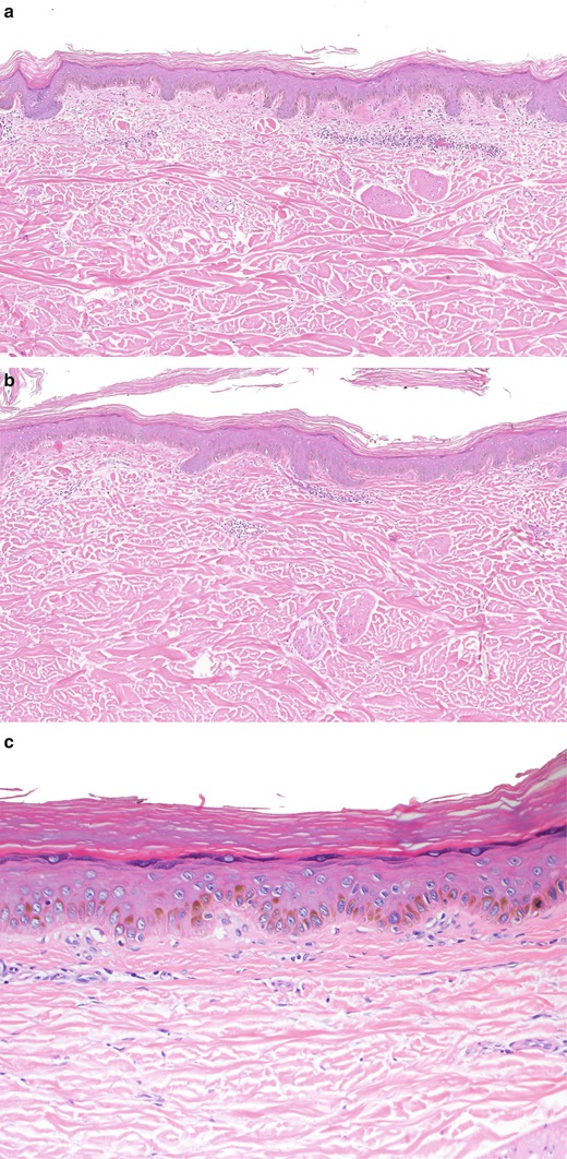 Fig 11 Ephelides Note the pigmented basal keratinocytes and the decreased - photo 3