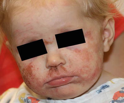 Fig 11 Atopic dermatitis presents as erythematous scaly plaques over the - photo 1