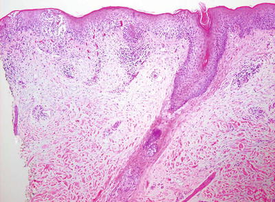 Fig 12 Atopic dermatitis presents with a mild spongiotic dermatitis and a - photo 2