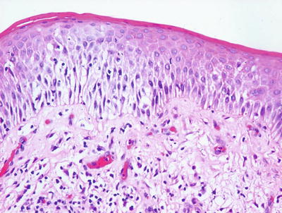 Fig 13 A spongiotic dermatitis with scant exocytosis of lymphocytes is seen - photo 3