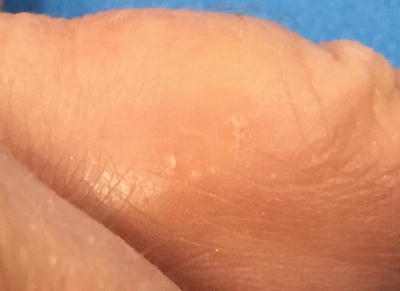 Fig 14 Dyshidrotic eczema presents as scaly papules and deep-seated vesicles - photo 4