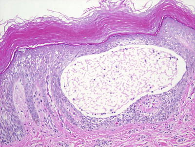 Fig 15 Acral skin demonstrating spongiotic dermatitis with microvesiculation - photo 5