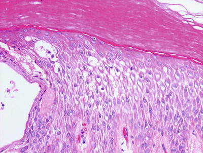 Fig 16 Dyshidrotic eczema reveals a spongiotic dermatitis on acral skin - photo 6