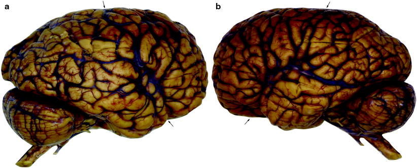 Fig 11 Lateral views of the right a and left b hemispheres still - photo 1