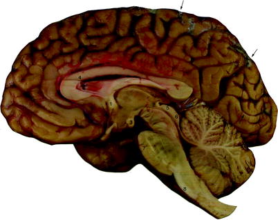 Fig 12 Medial view of the right hemisphere after removal of the - photo 2