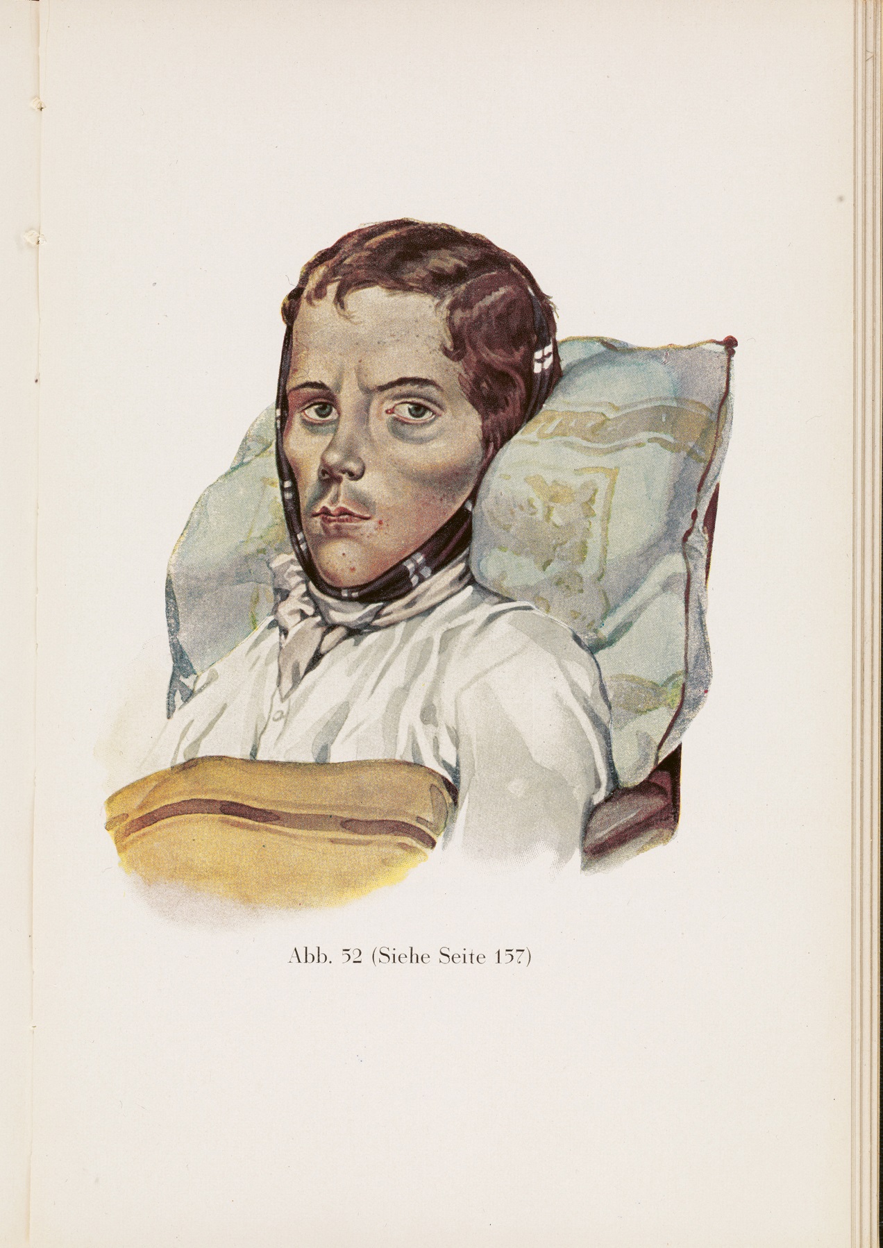 A 19th-century illustrations of a man with pulmonary tuberculosis a man with - photo 10