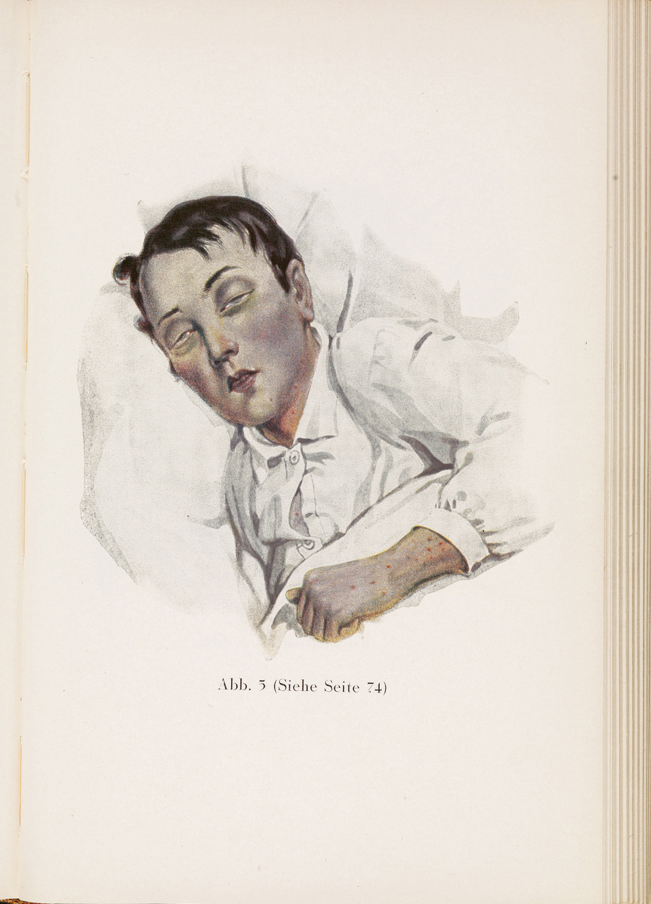 A 19th-century illustrations of a man with pulmonary tuberculosis a man with - photo 11