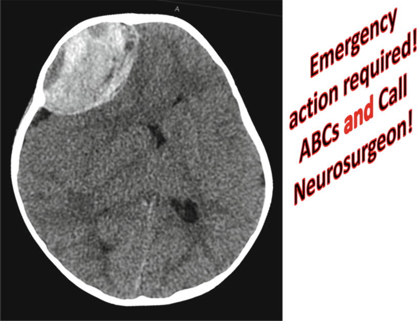 Figure 1 Epidural hematoma Emergency action required ABCs and call - photo 3