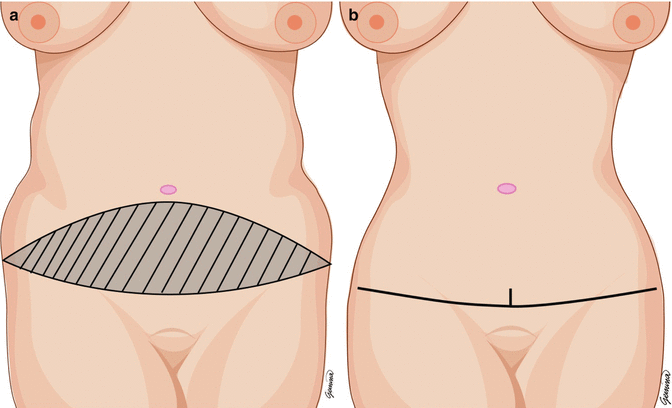 Fig 19 a Area of excision b Final scar Dufourmental and Mouly - photo 9