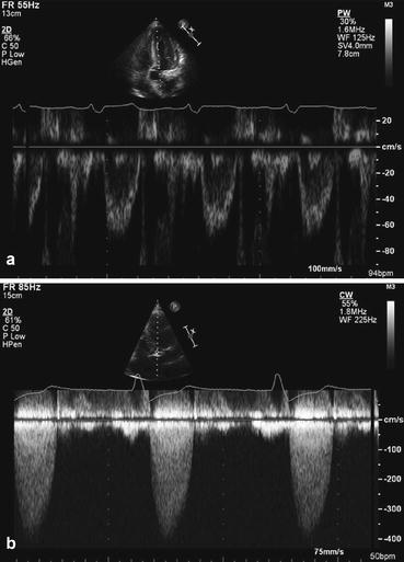 Fig 110 Doppler echocardiography As its name implies Doppler images are - photo 10