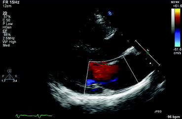 Fig 111 Color flow imaging Color flow imaging is used to detect the - photo 11