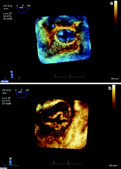 Fig 112 3D echocardiography 3D images are obtained using a pyramidal volume - photo 12