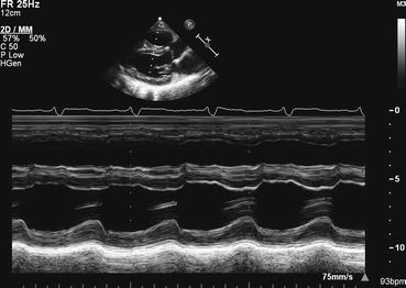 Fig 18 M-mode echocardiography M-mode motion-mode echocardiography is a - photo 8