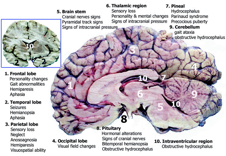 Fig 11 Coronal upper left and sagittal right autopsy specimens of the - photo 1