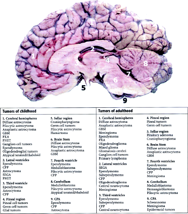 Fig 12 Sagittal autopsy specimen of the brain shows the distribution most of - photo 2