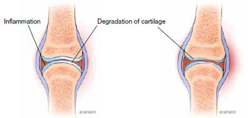 A left The first signs of osteoarthritis in a joint are microscopic pits and - photo 3