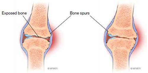 C left The subsurface bone thickens and spurs osteophytes develop Using - photo 4