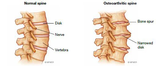 Elastic structures called disks cushion the vertebrae in a normal spine - photo 5