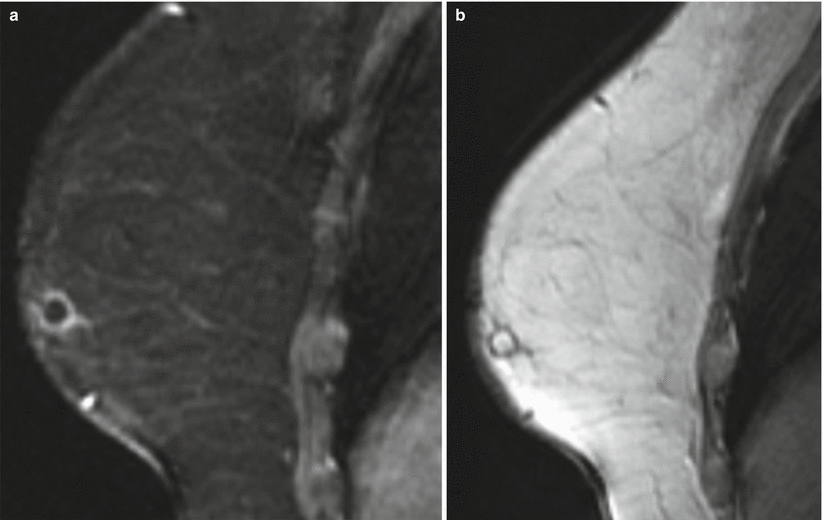 Fig 12 Sagittal T1 fat-saturated post-contrast image of the right breast a - photo 2