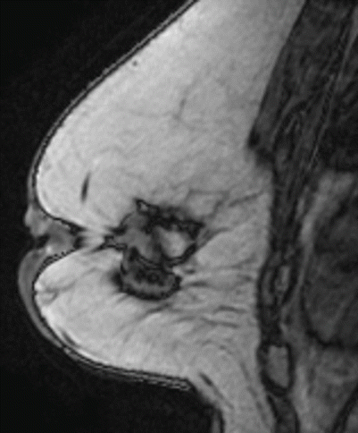 Fig 13 Sagittal T1 nonfat-saturated image of the left breast Fig 14 - photo 3