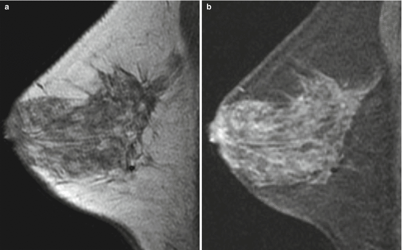 Fig 14 Sagittal T1 nonfat-saturated image of the right breast a and - photo 4