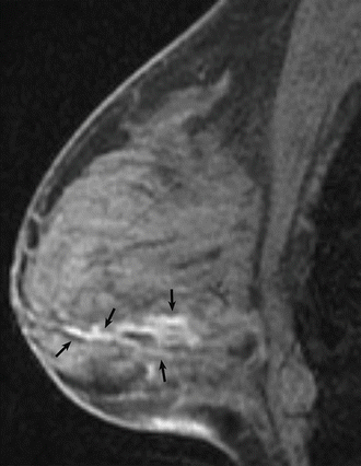 Fig 15 Hemorrhagic or proteinaceous debris in ducts Sagittal T1 - photo 5