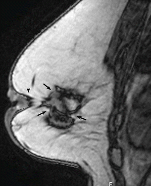Fig 17 Architectural distortion In a patient with prior lumpectomy the - photo 7